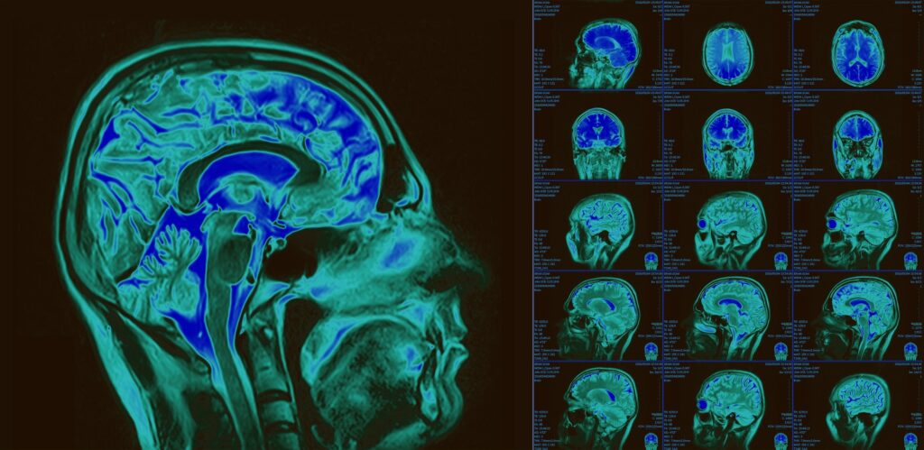 Materialist assumptions often ignore or dismiss the role of consciousness in shaping brain activity itself, argues Johns Hopkins' Dr. Christophe Morin. Neuroplasticity forces us to reconsider this oversight. The brain does not merely react; it is re-organized in response to intention, attention, and behavior. Studies in mindfulness and trauma recovery demonstrate that new neural pathways can form when individuals shift their patterns of thought and belief. These changes are not trivial: they suggest that mind—and the awareness behind it—is a causal force, Dr. Morin maintains.
