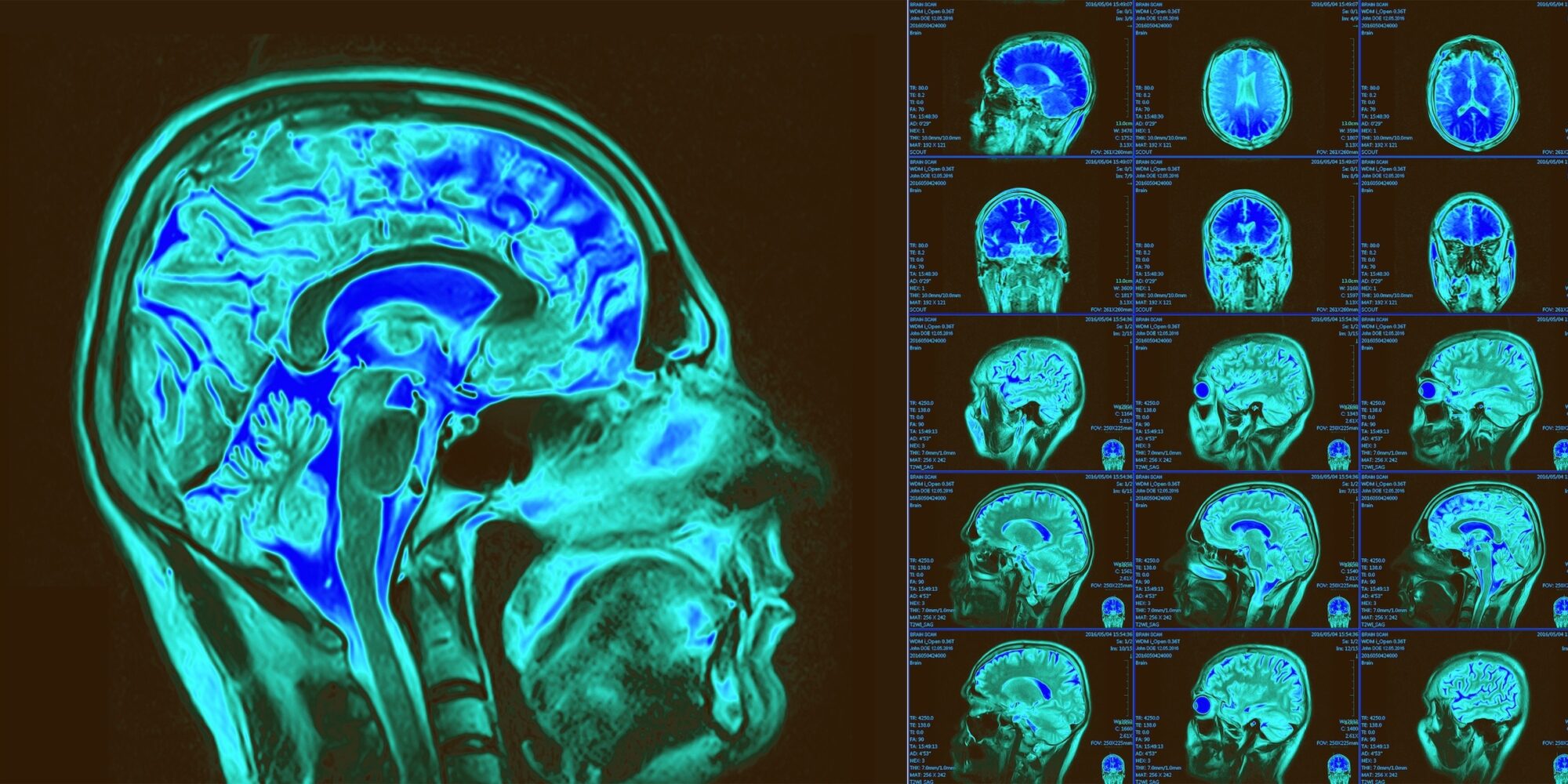 Magnetic resonance imaging of the brain. MRI scan